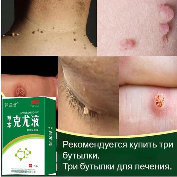 Используйте безопасный и не имеющий побочных эффектов раствор для снятия бородавок, чтобы быстро удалить куриный глаз