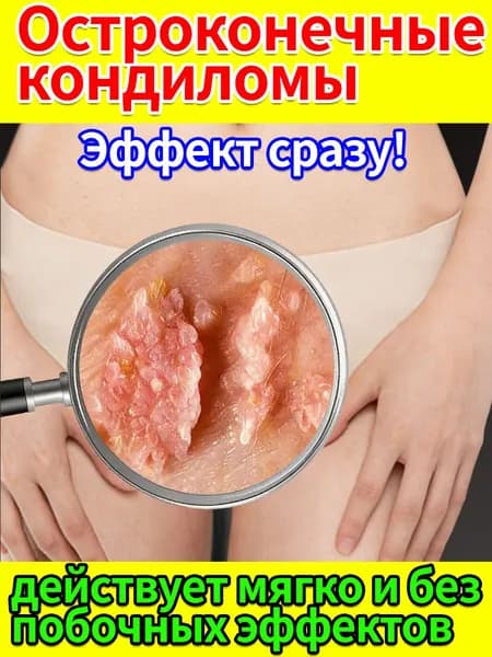 Крем для удаления остроконечных кондилом у женщин и мужчин. Лечение кондилом, папиллом ВПЧ в интимной зоне на коже. Средство от генитальных бородавок