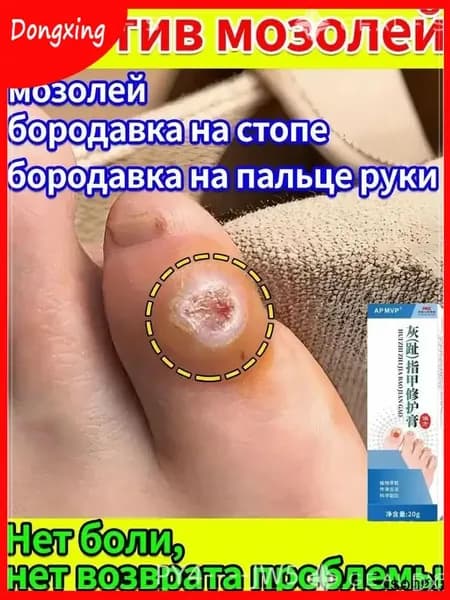 Лечебная мазь с пластырем для безболезненного устранения натоптышей, стержневых и сухих мозолей на пальцах и стопах, качественное средство от болезненных образований