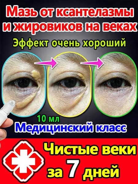 Средство от ксантелазмы без операции: уход за кожей век