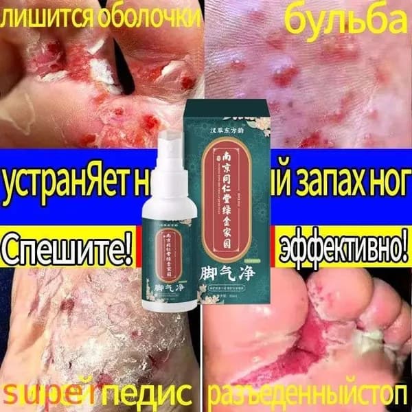 Фунгиспрей для ногтей, используется для трещин, зуда, грибковых заболеваний пяток и стоп, 35 мл