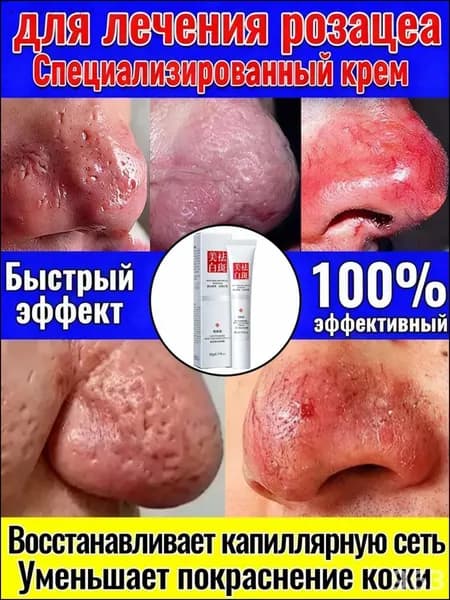 Эксклюзивный крем против розацеа и расширенных капилляров, 30 г, расширение сосудов и жирная кожа, одновременно устраняет отечность носа. ...