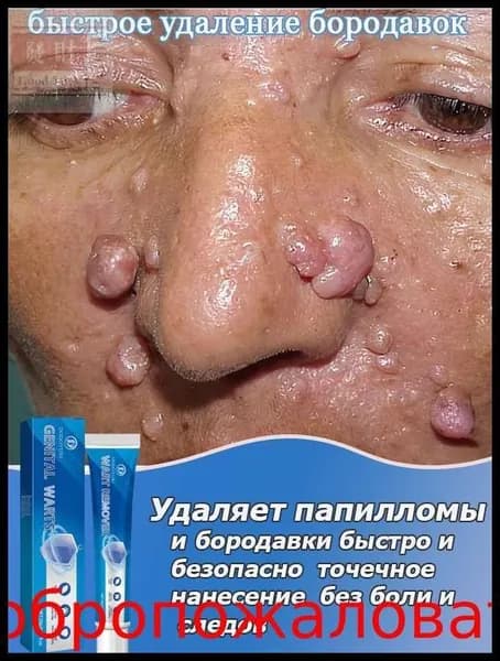 Крем от бородавок для рук, ног и лица, для удаления папиллом, бородавок и родинок, с экстрактом растений, 20 г