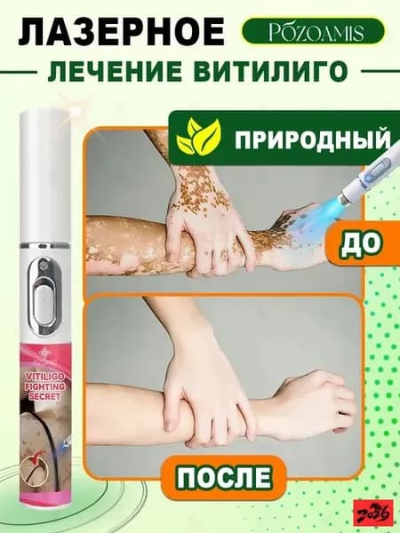 Лазерная ручка для коррекции витилиго - осветление пятен и выравнивание тона кожи