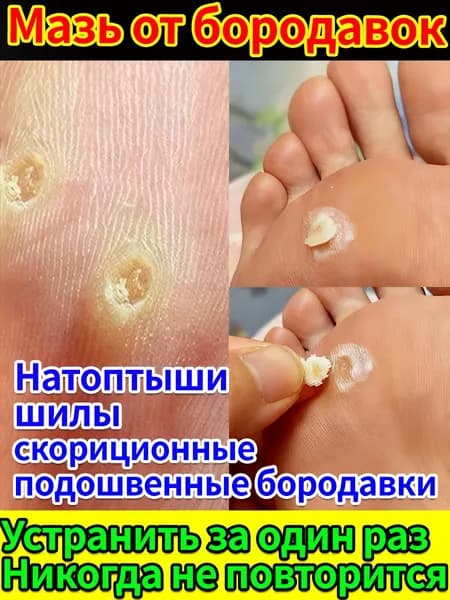 чистотел от папиллом и бородавок: избавление от шипиц, сухих мозолей и трещин за один курс