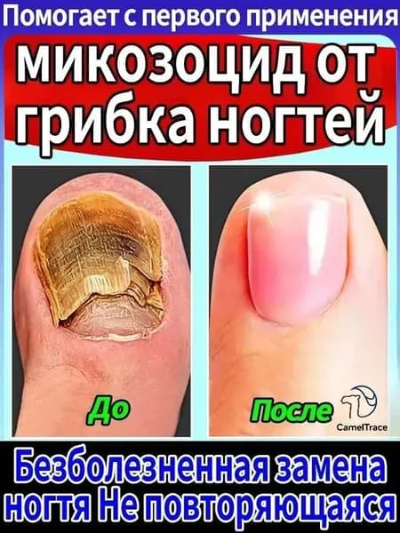 Противогрибковая мазь Ноготок от грибка ногтей на ногах и гиперкератоза, противогрибковое средство для ног,укрепляйте и восстанавливайте ногти, крем для лечения 100g