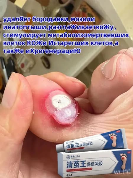 Мазь от шипиц, подошвенных и ладонно-подошвенных бородавок, натоптышей и мозолей на ногах - эффективное удаление и лечение для женщин и мужчин