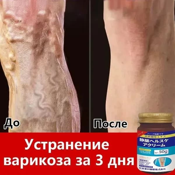 Мазь от варикоза 50 г снимает боль улучшает циркуляцию уменьшает расширение вен