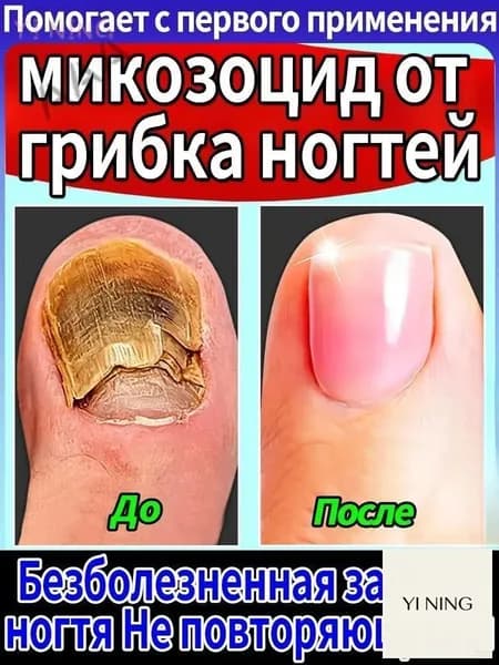 Противогрибковая мазь Ноготок от грибка ногтей на ногах и гиперкератоза, противогрибковое средство для ног,
