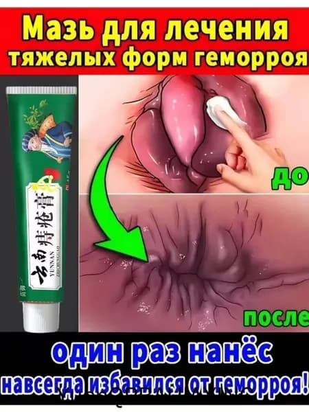 Чудодейственный восстанавливающий крем для устранения геморроя и опухолей, способствующий заживлению анальных трещин и устранению зуда;