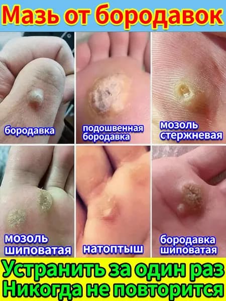 Удаление подошвенных бородавок и шипиц - средство от мозолей и натоптышей