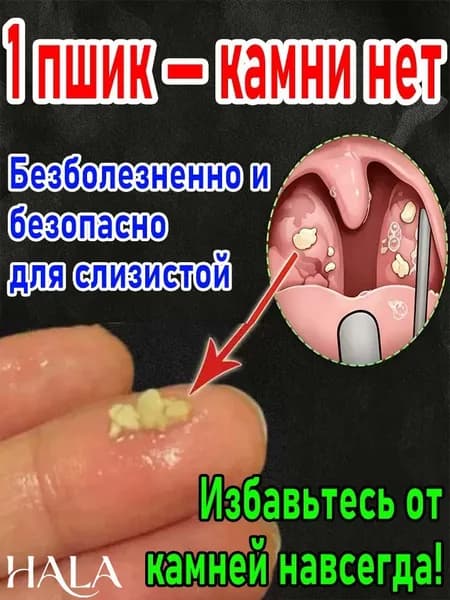 Набор для очистки миндалин: ирригатор и спрей для удаления пробок в домашних условиях
