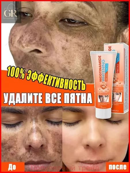 Крем для удаления веснушек и отбеливания способен удалить веснушки, хлоазму, солнечные пятна, пигментные пятна, улучшить тусклый тон кожи, бороться с пигментацией и выравнивать тон кожи.20ml
