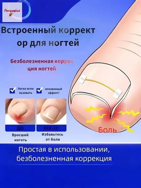 Комплект из 10 никелид-титановых корректоров для вросших ногтей