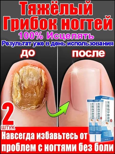 2 штуки,крем ноготок от грибка ногтей на ногах,ноготок мазь от грибка на ногах,гиперкератоз