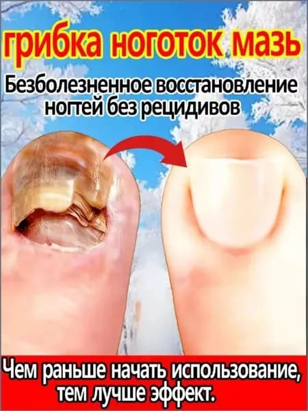 Противогрибковый спрей, от грибка ногтей на ногах, от трещин, для пяток и стоп, мазь от псориаза, зуда, микозе, спрей для ног