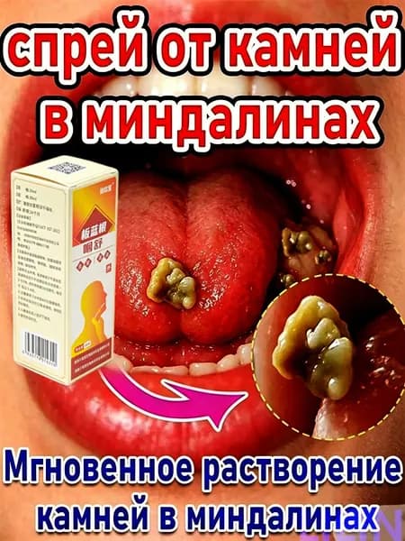 Набор для удаления камней миндалин + спрей