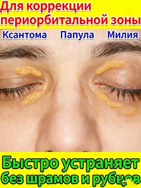 Крем от ксантелазмы, милиумов и халязиона для кожи вокруг глаз