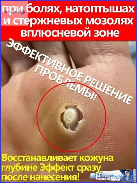 Скидка сегодняпри болях, шишках и в плюсневой зоне, от стержневых шишек 20 г
