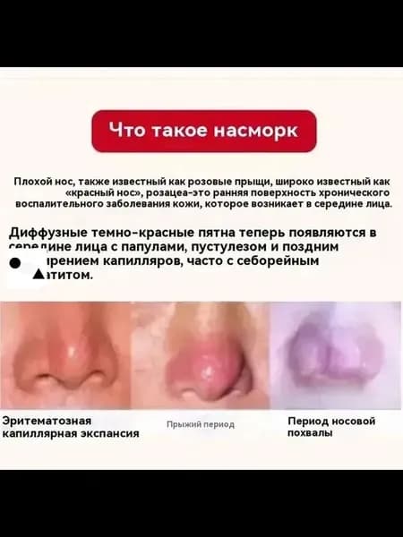 крем от розацеаисцеление красный нос и прыщи