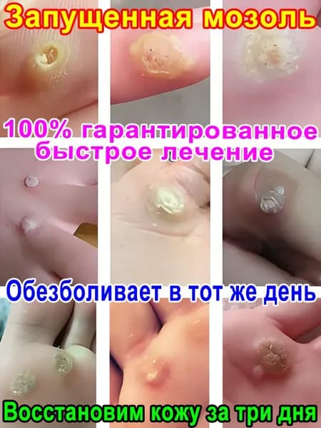 Мазь от шипиц, подошвенных и ладонно-подошвенных бородавок, натоптышей и мозолей на ногах - эффективное удаление и лечение для женщин и мужчин.ингредиенты китайской медицины.
