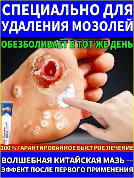 Крем от сухих мозолей стержневых, бородавок, натоптышей, шипиц и пяточных шпор,китайская чудо-мазь
