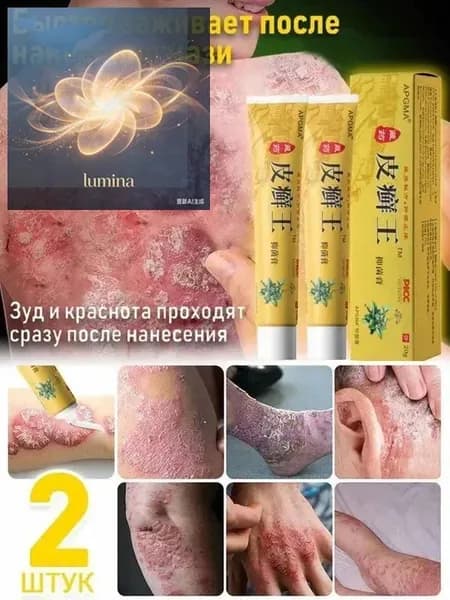 Мазь от псориаза экземы и грибка ногтей на ногах