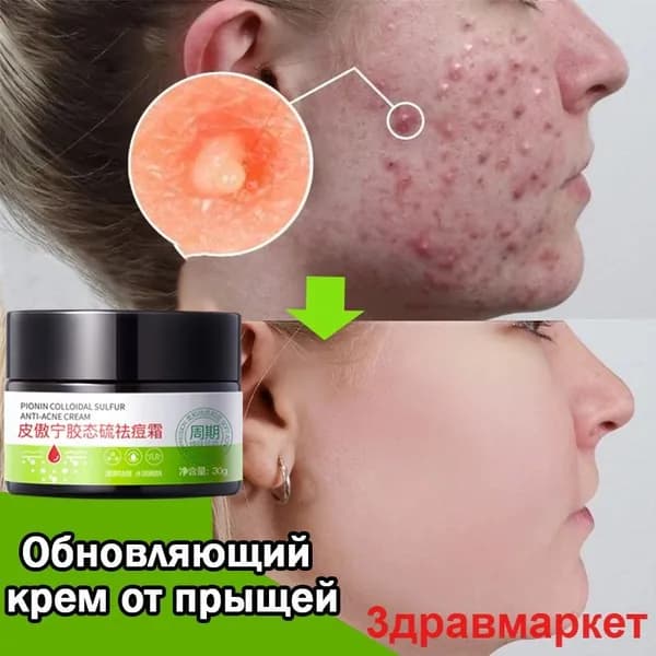 Крем для лица от акне прыщей воспалений 30г,от черных точек и угрей, жирной и чувствительной кожи,Подходит для лица, ягодиц и тела, для подростков и взрослых