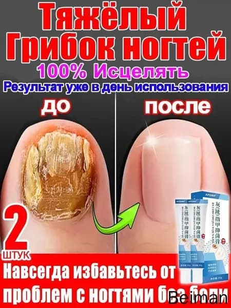 2 штуки,крем ноготок от грибка ногтей на ногах,ноготок мазь от грибка на ногах,гиперкератоз