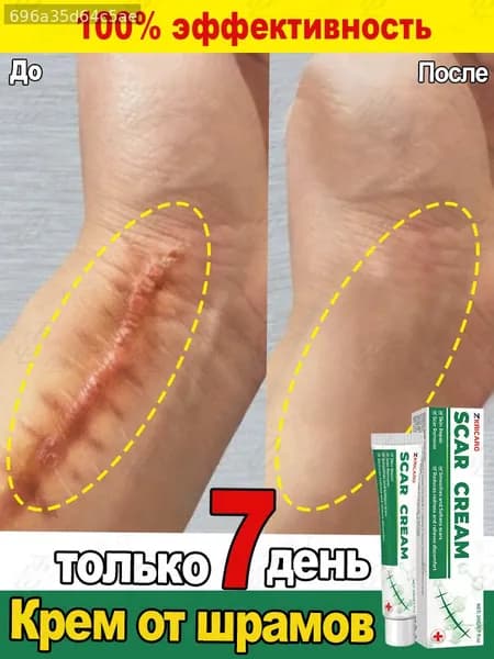 Крем от шрамов и рубцов, гель от прыщей на лице, мазь против ожогов и пигментных пятен и теле, средство от постакне30 г