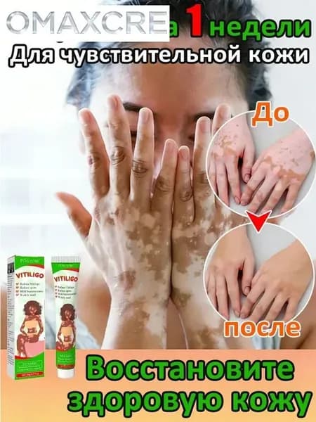 Мазь от витилиго,Средство при нежелательной пигментации витилиго.20 мл