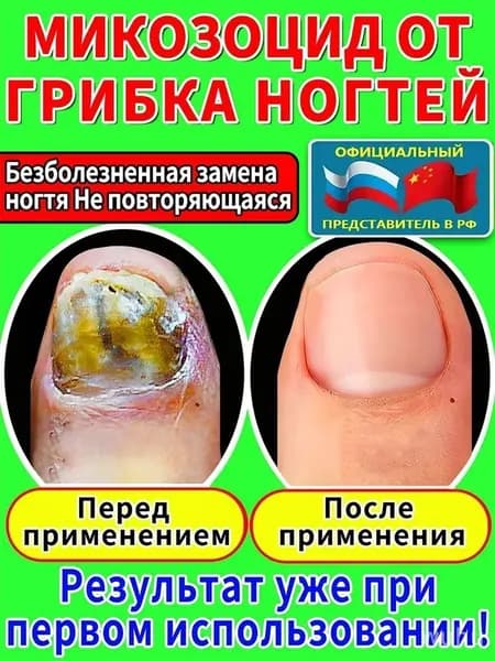Противогрибковая мазь Ноготок от грибка ногтей на ногах и гиперкератоза, противогрибковое средство для ног,укрепляйте и восстанавливайте ногти