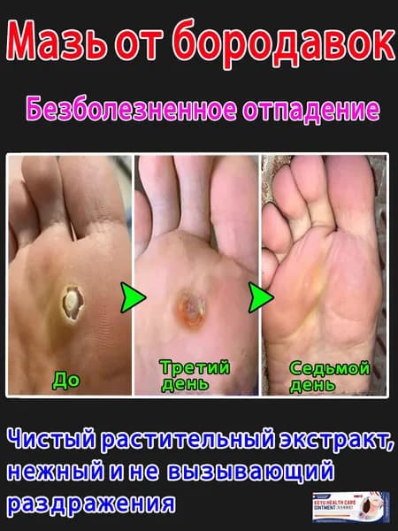 Китайская мазь для лечения сухих мозолей, бородавок, натоптышей и шипиц.