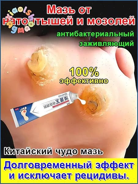 Качественный крем 20 г для удаления стержневых мозолей, сухих натоптышей, шипиц и бородавок