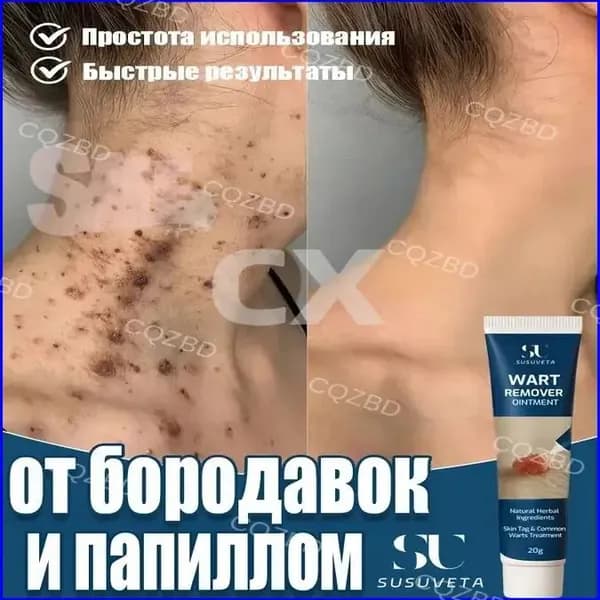 SUSUVETA Крем от папиллом и бородавок, средство для удаления новообразований. Эффективное средство для быстрого удаления папиллом и бородавок, 20 мл.