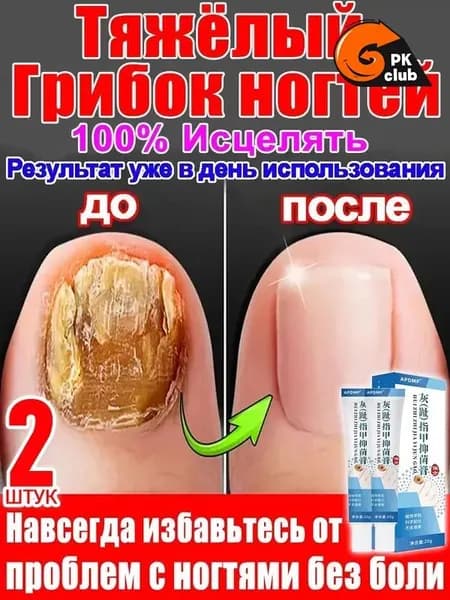 2 штуки,крем ноготок от грибка ногтей на ногах,ноготок мазь от грибка на ногах,гиперкератоз