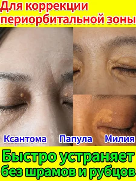 Крем-актив для удаления милиумов на лице и глазах, лечение ксантом и ксантелазмы видимый результат