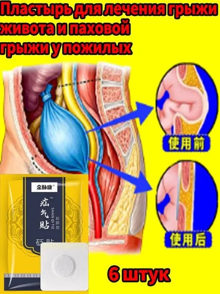 6 пластырей для лечения брюшной грыжи и паховой грыжи у пожилых людей