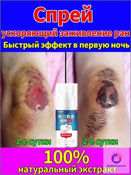 Спрей для лечения диабетической стопы и пролежней: заживление ран и регенерация кожи при сахарном диабете