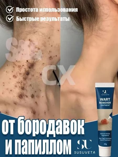 SUSUVETA Крем от папиллом и бородавок, средство для удаления новообразований. Эффективное средство для быстрого удаления папиллом и бородавок, 20 мл.