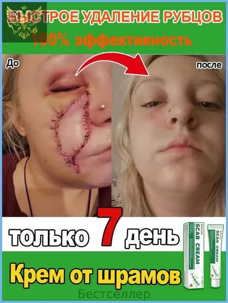 Крем для удаления шрамов. Быстро удаляет шрамы, растяжки, следы от акне и ожогов. Мягкий и не раздражающий, подходит как мужчинам, так и женщинам. 20 мл