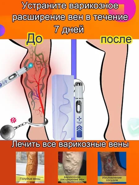 Лазерное лечение варикозного расширения вен. эффективное и быстрое удаление, безболезненное, без шрамов, без побочных эффектов