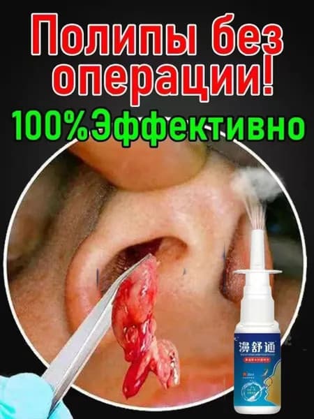 Спрей от полипов в носу без операции, 20 мл