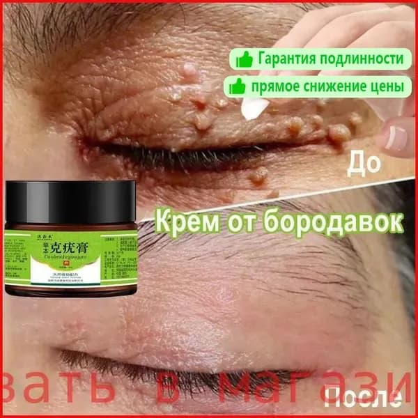 Бородавки крем для снятия и родовой площадью 20 г папиллом бородавок на проблемной коже
