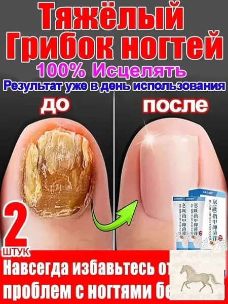 2 штуки,крем ноготок от грибка ногтей на ногах,ноготок мазь от грибка на ногах,гиперкератоз