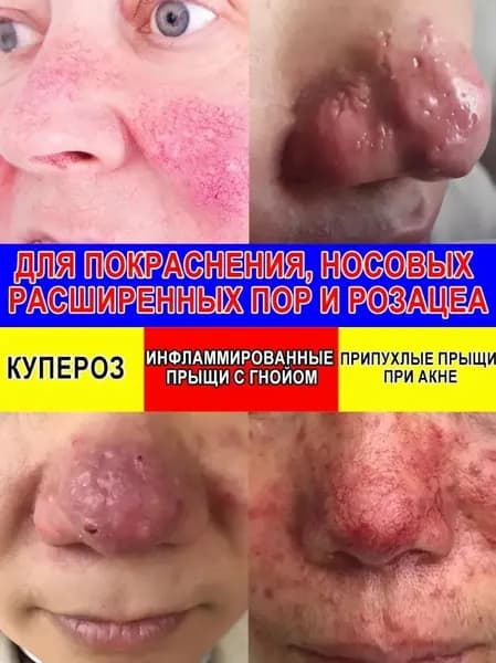 Увлажняющий крем от купероза, эритематозной розацеа и покраснений проблемной кожи, эмболии капилляров, 20 грамм