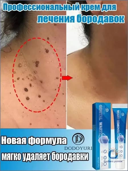 ДОДОЮРИ, мазь для лечения папиллом, крем для удаления бородавок, папиллом и родинок. Безболезненный, не оставляет следов, без побочных эффектов. 20 г.