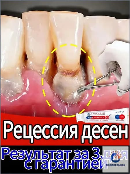 Эксклюзивный гель с регенерирующим кремнием применяется для восстановления десен и укрепления зубов при рецессии