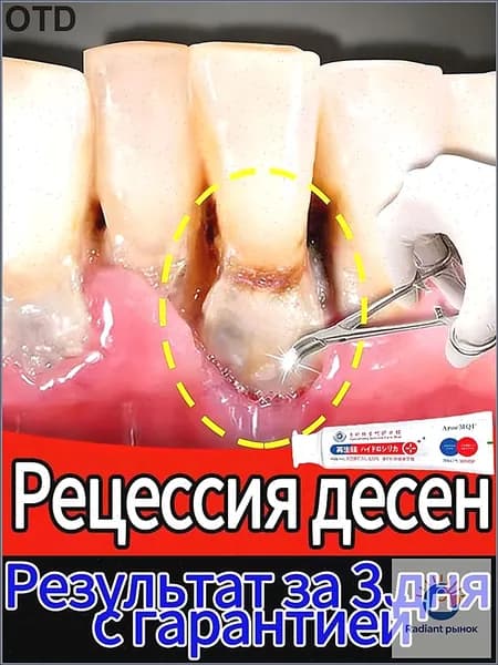 Восстановление десен и укрепление зубов при рецессии - гель с регенерирующим кремнием