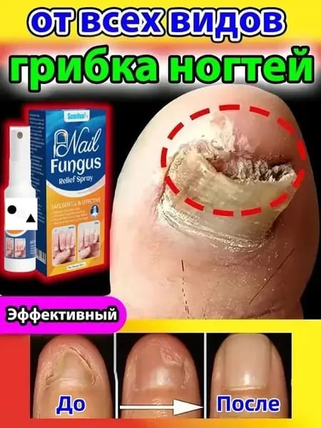Спрей от грибка ногтей, для лечения грибка и онихолизиса, восстановления и роста / 30 мл